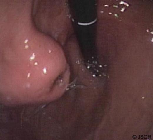 Gastroscopy revealing bleeding gastric lesion