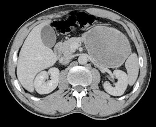 Axial CT scan showing a large lesion related to the stomach in the left upper quadrant