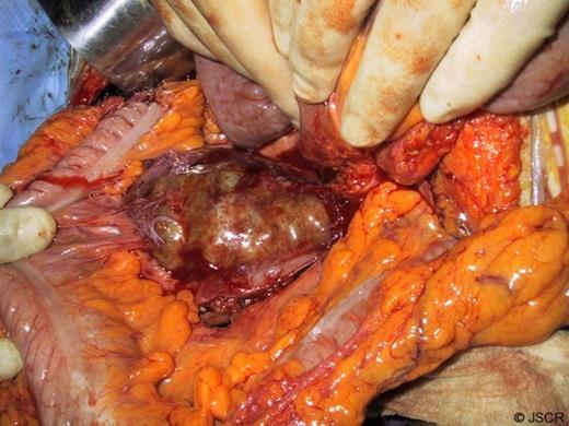 Large heterogenous mass found at laparotomy