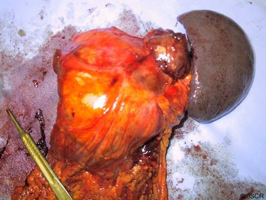 En-bloc resection