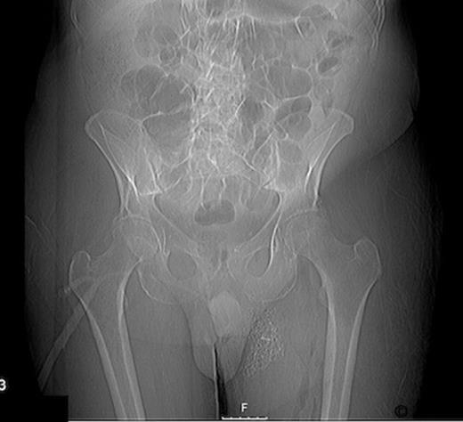 Abdominal radiograph