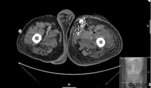 Pelvic CT with contrast media