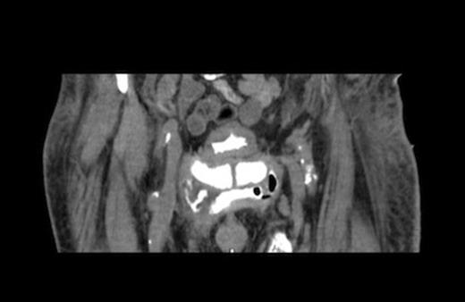 Figures 2, 3, and 4 are axial, sagittal, and coronal views, respectively, of computed tomography with contrast introduced by urinary catheter. This CT cystogram shows a leak/fistula at the low anterior bladder wall. The fistula has a communication with the pubic symphysis and a collection lies anterior to this. The tract extends distally, communicating with the cavity in the left anteromedial aspect of the thigh.