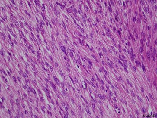 Microphotograph of leiomyosarcoma. Hematoxylin and eosin stain demonstrates a highly cellular, pleomorphic, and spindle shaped tumor with few mitotic figures (400×).