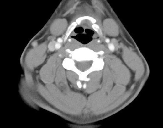 Dislocation of the symphysis between the left greater cornu and the body of the hyoid bone