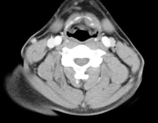 Minor asymmetry of the left valeculla
