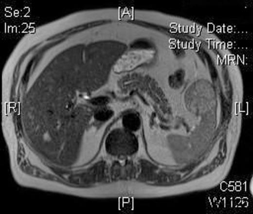 T2W weighted image demonstrating a well circumscribed, round mass arising exophytically from the anterior aspect of the spleen with an intermediate T2W signal intensity.