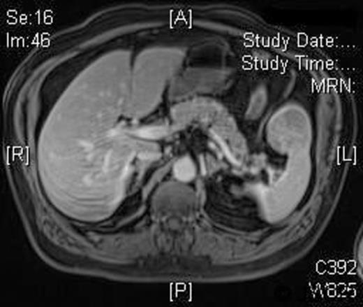T1W post-gadolinium MRI: the mass demonstrates a degree of late enhancement