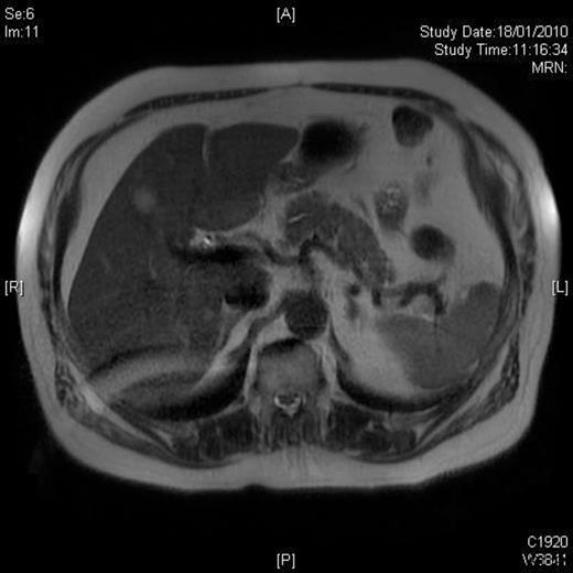 MRI post-resection: T2W image showing absence of the lesion