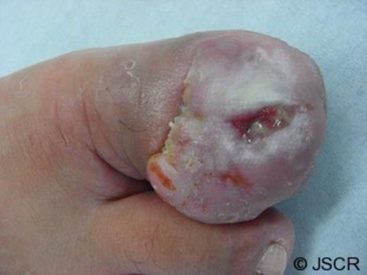 The first toe of a 56-year-old man. Photograph shows epithelized granulation tissue on the nail plate and fistulation from the proximal nail fold to the tip of the toe