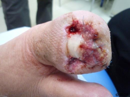 Bilateral chemical matricectomy of the matrix was done with phenol after resection of the tumor