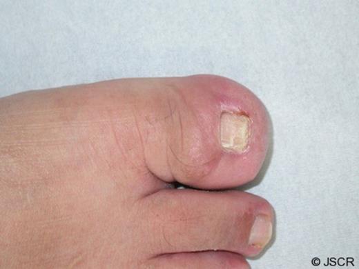 Eighteen months after the operation there was no recurrence of the ingrown toenail