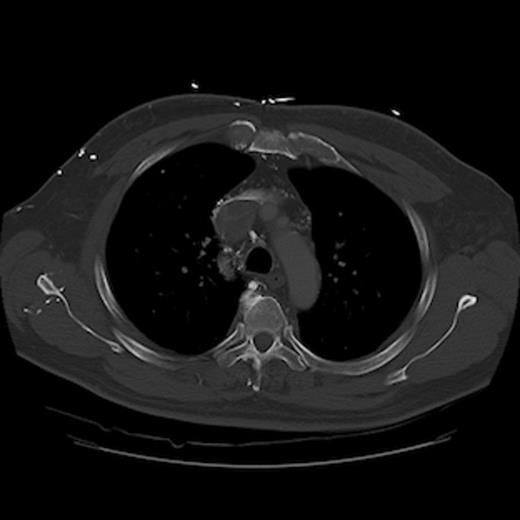 CT of the chest (axial section) with intravenous contrast: demonstrates complete obstruction of the superior vena cava with a large intramural thrombus
