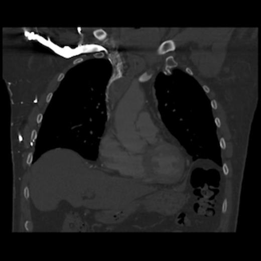 CT of the chest (coronal section) with intravenous contrast: demonstrates complete obstruction of the superior vena cava by a large intramural thrombus that extends into brachiocephalic vein