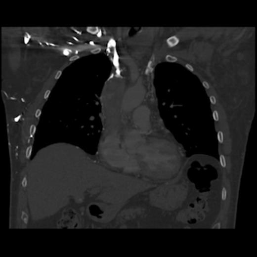 CT of the chest (coronal section) with intravenous contrast: demonstrates large thrombus obstructing the superior vena cava down to the right atrium