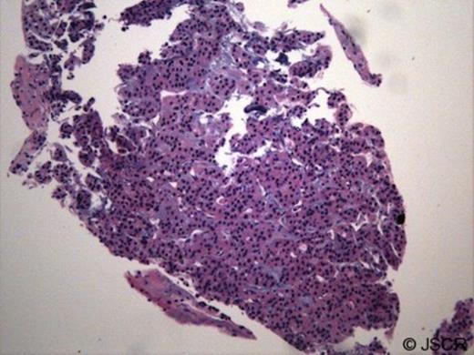 Microscopic examination of the mediastinal mass biopsy (H and E stain): revealed tumour cells with benign appearance and histologic features consistent with paraganglioma
