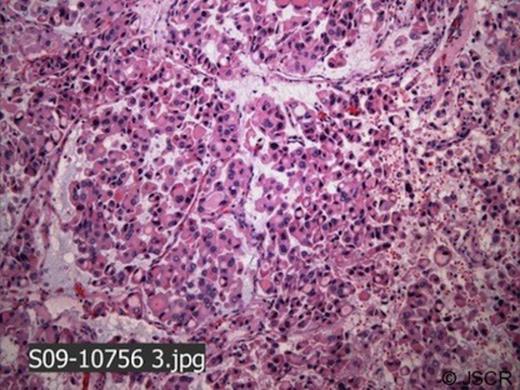 Microscopic examination of resected thyroid gland (H and E stain) demonstrates invasive thyroid follicular carcinoma with hurthle cell features and extensive angioinvasion.