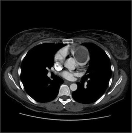CT Thorax demonstrating a mass within the right ventricle