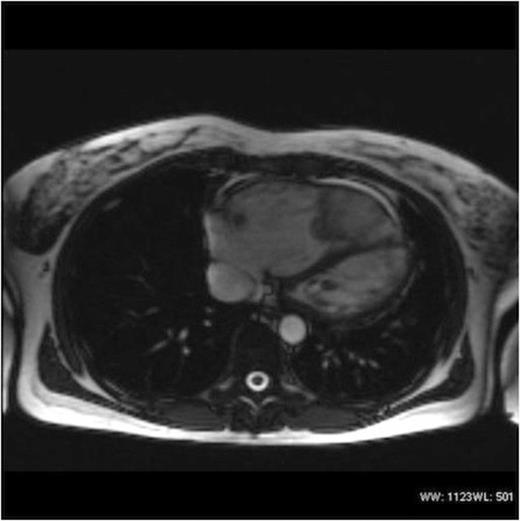 MRI Thorax demonstrating the same mass as in Figure 1