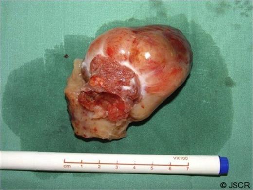The resected ventricular myxoma