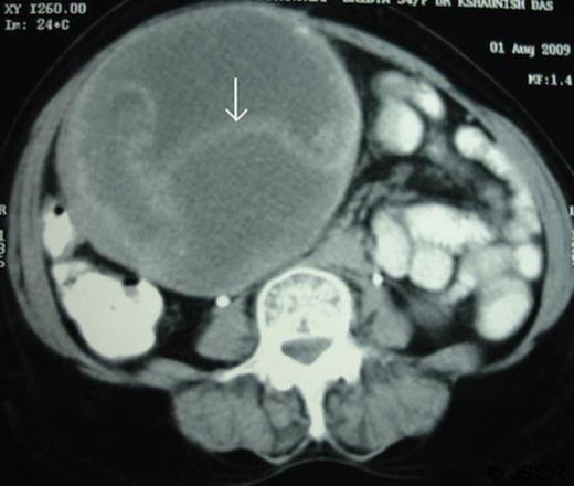 CT scan abdomen (both oral and intravenous contrast) showed a mass in right upper quadrant with displacement of gut loops towards the left. The mass showed contrast enhanced internal septa (white arrow)