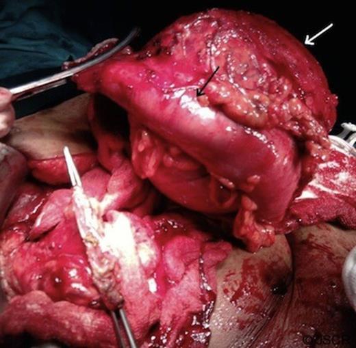 Operative photograph showing a large mass (white arrow) with adherent transverse colon (black arrow).