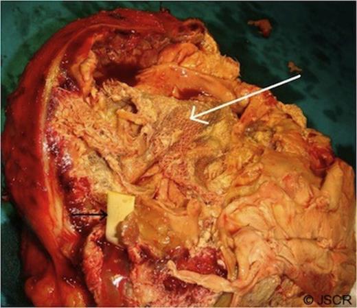 Cut section of the mass showing a large sponge (white arrow) and a radio-opaque marker (black arrow) within it.