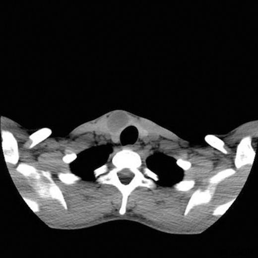 CT scan of schwannoma of ansa cervicalis