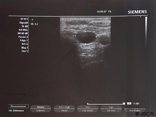 Ultrasonographic view of the neck revealed a cystic mass in the left pole of the thyroid