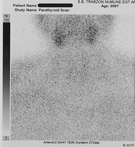 Sestamibi scintigraphy shows no focal uptake for parathyroid disease