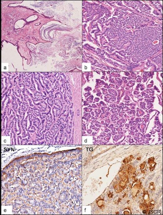 Panel depicting microscopic findings: Ectodermal component in the form of skin and underlying adnexal structures lined the cystic spaces ( a, 4x H&E). Monomorphic tumor cells in a variety of neuroendocrine architectural patterns including acinar and trabecular arrangements were seen ( b, 10x H&E; c, 20x H &E) At places colloid filled follicles were identifiable ( d, 20x H &E). Immunohistochemistry showed diffuse cytoplasmic reactivity for synaptophysin throughout the tumor ( e, 20x) and focal cytoplasmic reactivity for thyroglobulin which also stained the central colloid ( f, 20x)