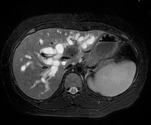 MRI of the liver showing lesion at the confluence of right and left hepatic ducts with extension in to the left duct.