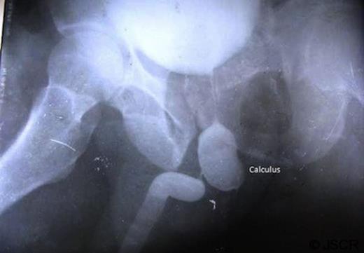 Retrograde urethography