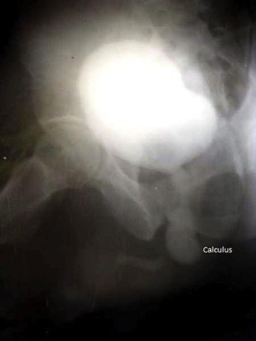 Micturiting cystourethography