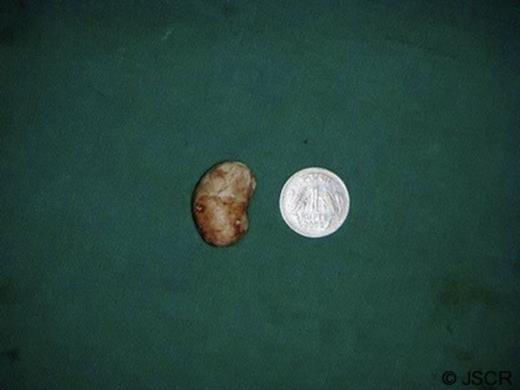 Successfully extracted calculus