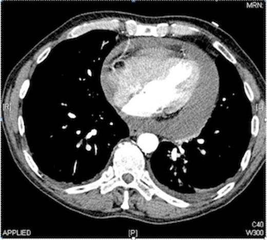 CT Slice showing pericardial effusion