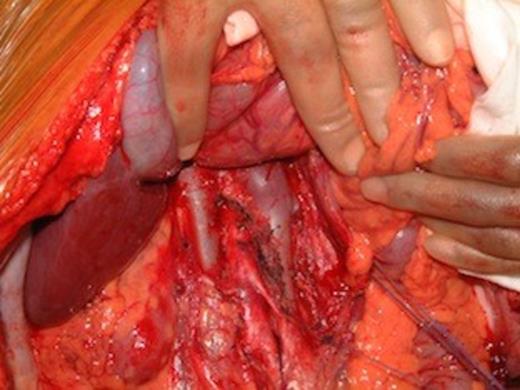 Intra-operative photograph of double IVC in a deceased multi organ donor