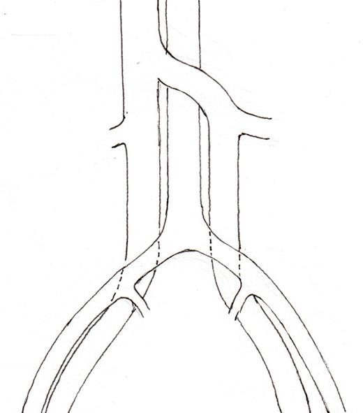 Schematic representation of common disposition of double IVC. (2a) common variant, left IVC crossing in front of the aorta, (2b) The left IVC passes behind the aorta, (2c) Transposition of IVC (left IVC), (2d) circum aortic left renal vein.