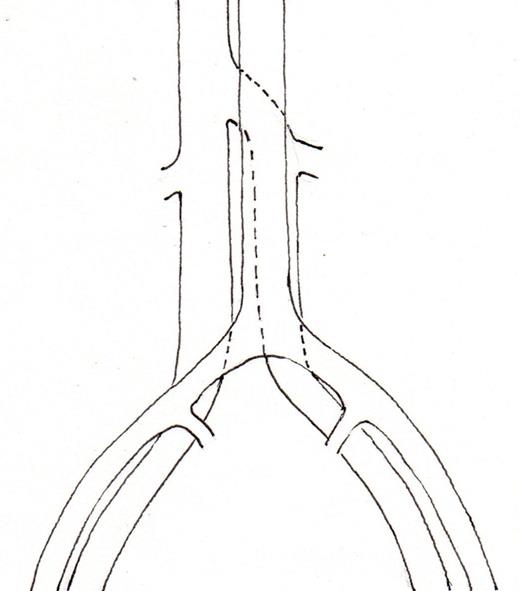 Schematic representation of common disposition of double IVC. (2a) common variant, left IVC crossing in front of the aorta, (2b) The left IVC passes behind the aorta, (2c) Transposition of IVC (left IVC), (2d) circum aortic left renal vein.