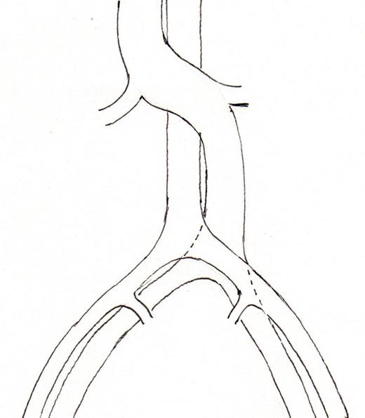 Schematic representation of common disposition of double IVC. (2a) common variant, left IVC crossing in front of the aorta, (2b) The left IVC passes behind the aorta, (2c) Transposition of IVC (left IVC), (2d) circum aortic left renal vein.