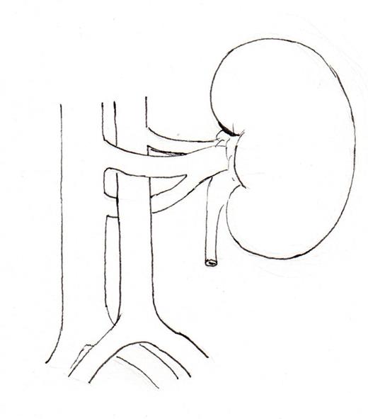 Schematic representation of common disposition of double IVC. (2a) common variant, left IVC crossing in front of the aorta, (2b) The left IVC passes behind the aorta, (2c) Transposition of IVC (left IVC), (2d) circum aortic left renal vein.