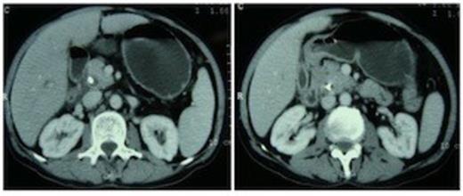 Computed tomography scan showing pancreatic head and uncinate process with absence of neck anterior to the portal vein. An ill-defined hypodense mass is seen in the ampullary region. Biliary stent is in situ.