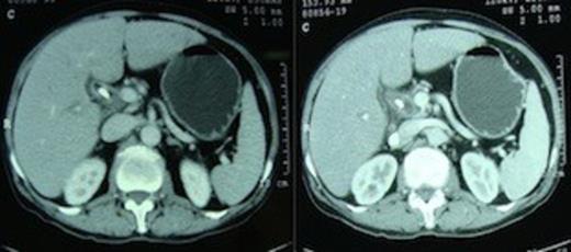 Computed tomography scan demonstrating absence of the body and tail of pancreas anterior to the splenic artery and vein.