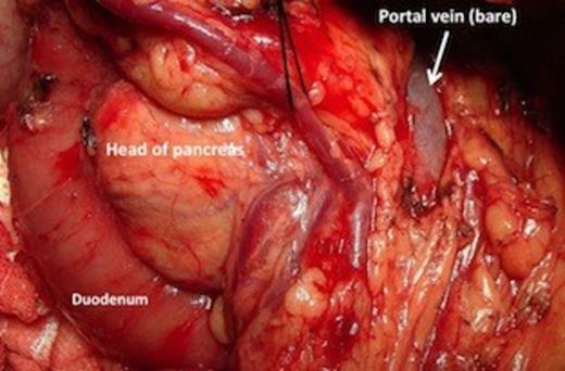 Operative picture showing the bare portal vein with absent neck, body and tail of pancreas.