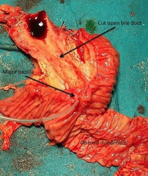 Pancreaticoduodenectomy specimen with longitudinally cut open medial wall of duodenum and bile duct showing only the major papilla (cannulated with a tube) with ampullary growth, minor papilla is absent.