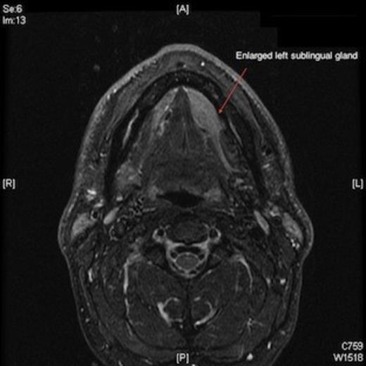 Magnetic resonance imaging scan showing enlarged left sublingual gland.