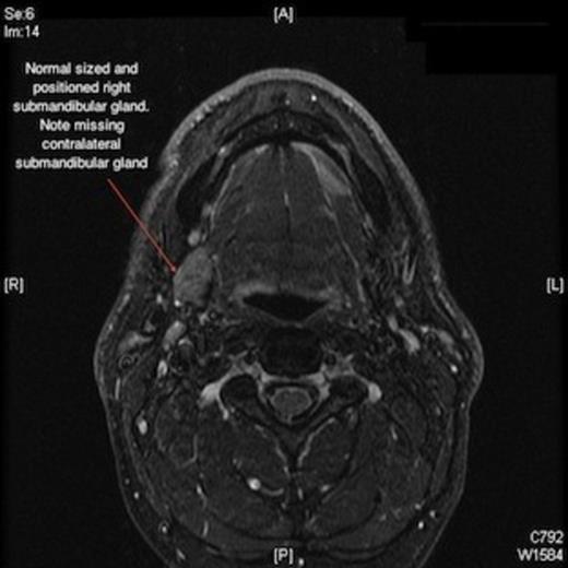 Magnetic resonance imaging scan showing missing left submandibular gland