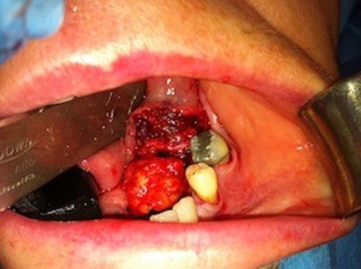 Intraoperative view of left sublingual gland