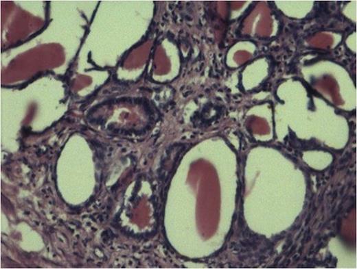 Tubules showing thyroidisation favouring chronic pylonephritis. (100x H and E stain).