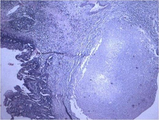 Cyst lined by metaplastic epithelium with focus of malignant squamous cell. (100x H and E stain)